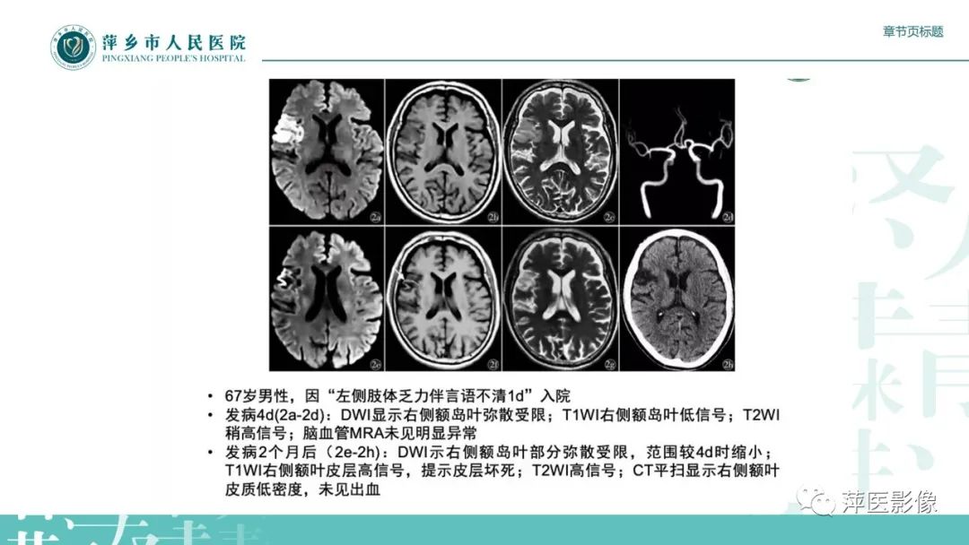 【PPT】脑皮质层状坏死的影像诊断-20