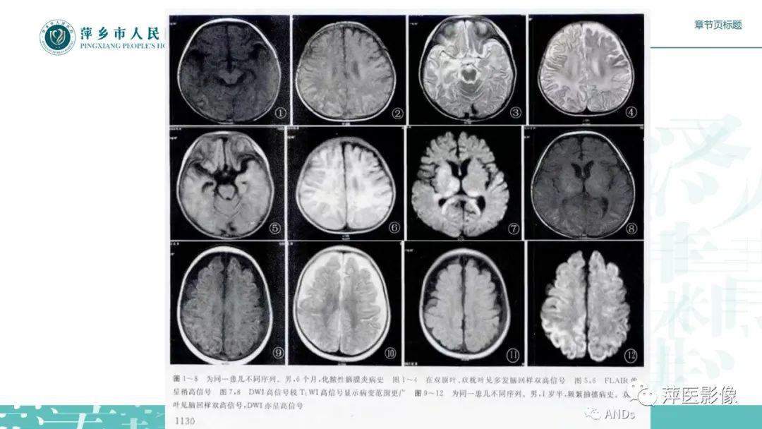 【PPT】脑皮质层状坏死的影像诊断-21