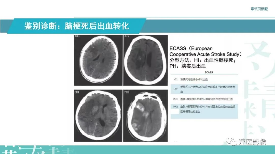 【PPT】脑皮质层状坏死的影像诊断-27