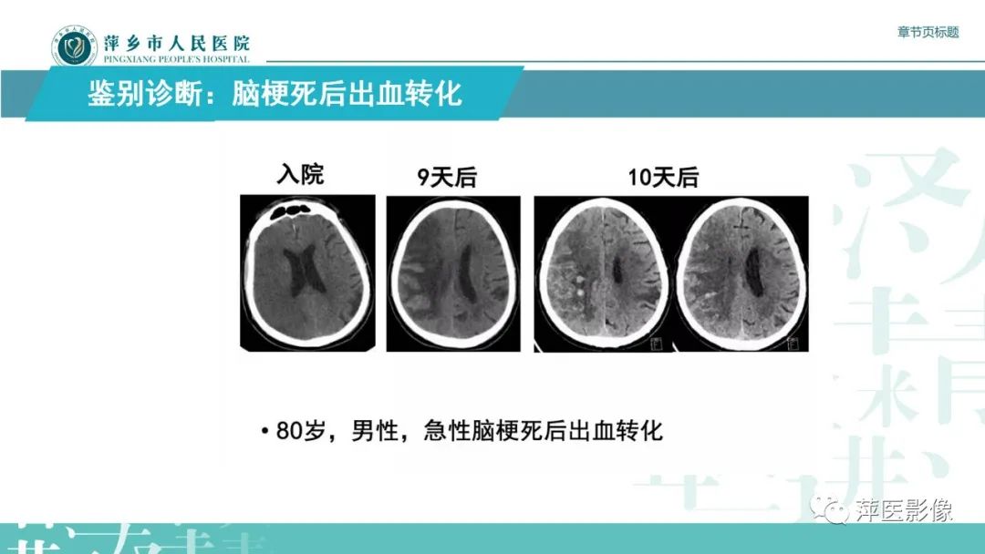 【PPT】脑皮质层状坏死的影像诊断-28