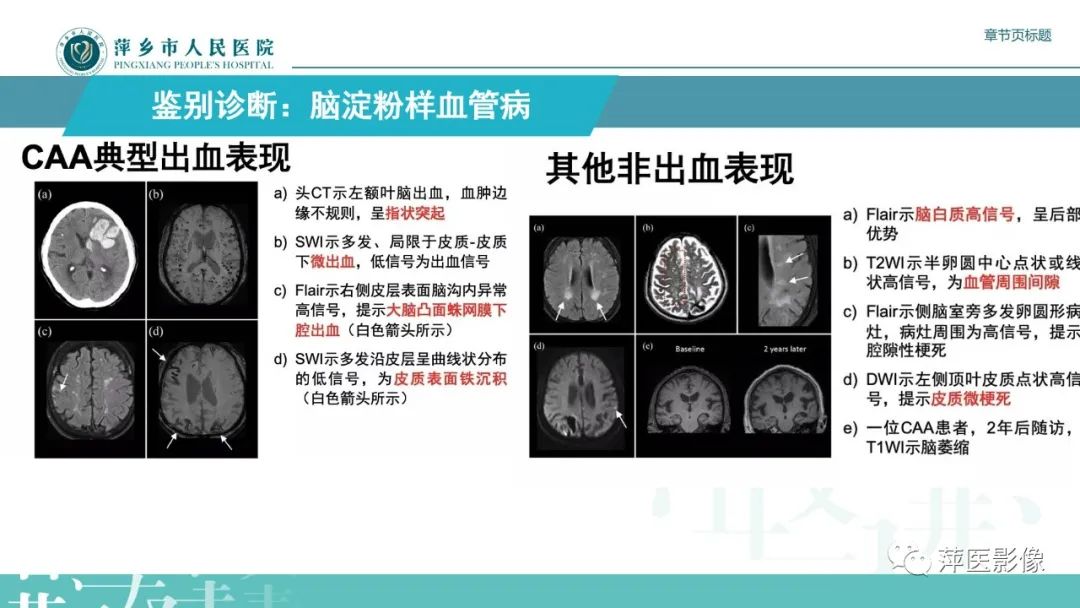 【PPT】脑皮质层状坏死的影像诊断-31