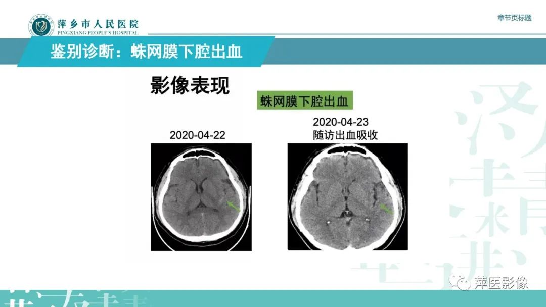 【PPT】脑皮质层状坏死的影像诊断-33