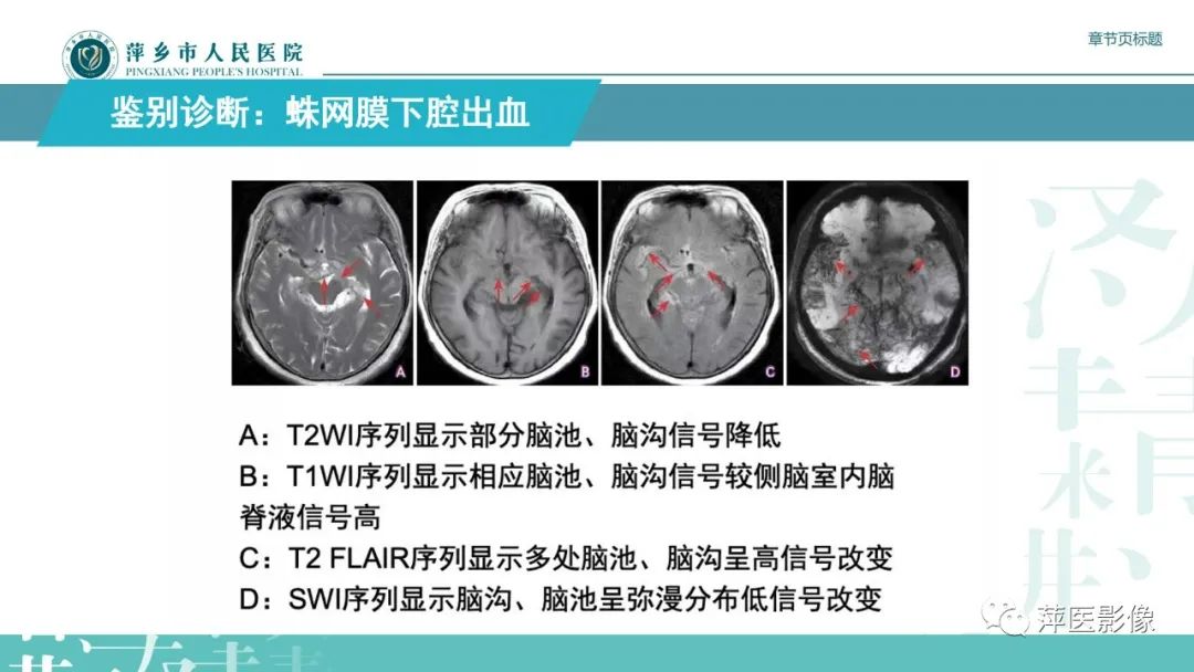 【PPT】脑皮质层状坏死的影像诊断-34