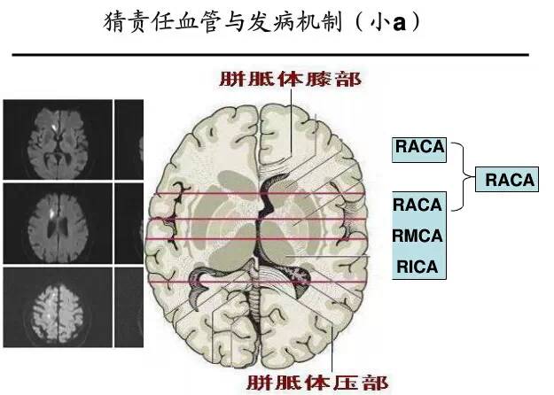 【PPT】猜责任血管与发病机制-4