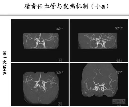 【PPT】猜责任血管与发病机制-5