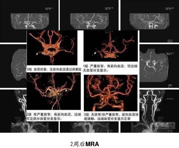 【PPT】猜责任血管与发病机制-6