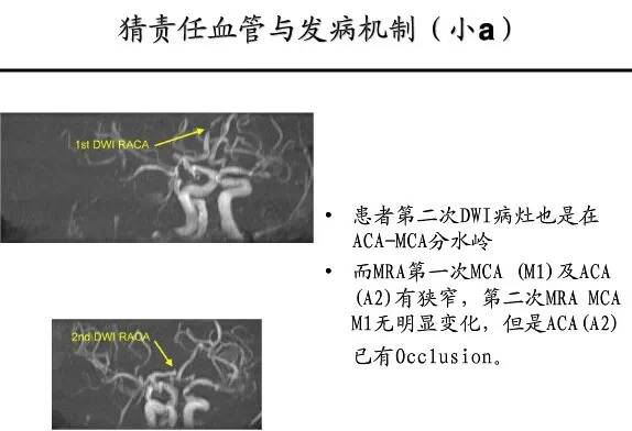 【PPT】猜责任血管与发病机制-7