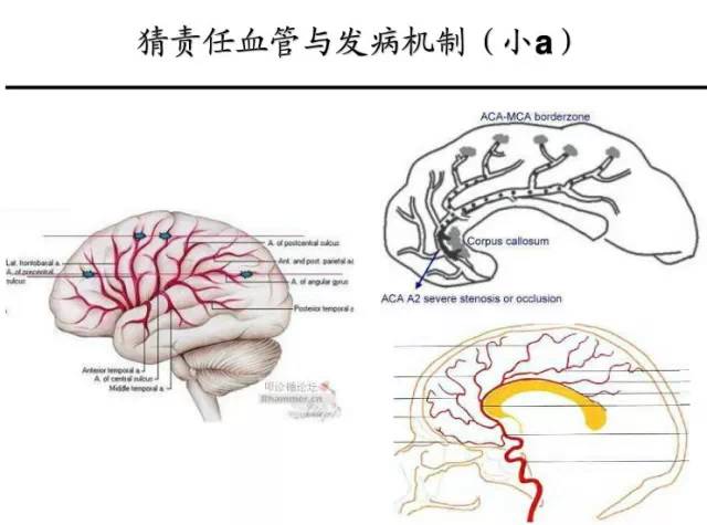 【PPT】猜责任血管与发病机制-8