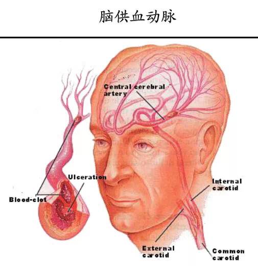 【PPT】猜责任血管与发病机制-12