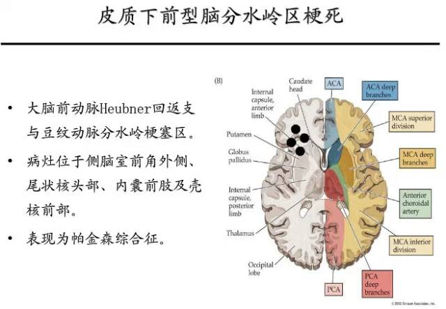 【PPT】猜责任血管与发病机制-51