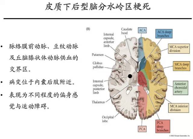 【PPT】猜责任血管与发病机制-52