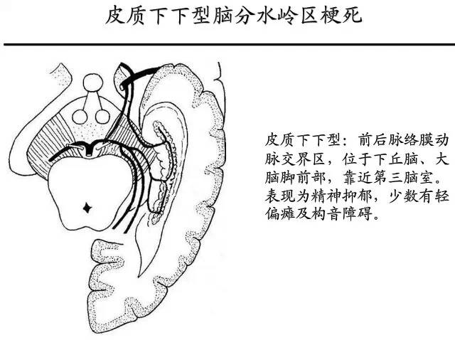 【PPT】猜责任血管与发病机制-56