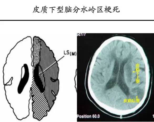 【PPT】猜责任血管与发病机制-54