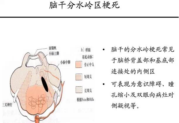 【PPT】猜责任血管与发病机制-58