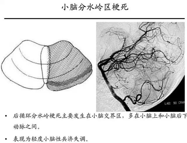 【PPT】猜责任血管与发病机制-57