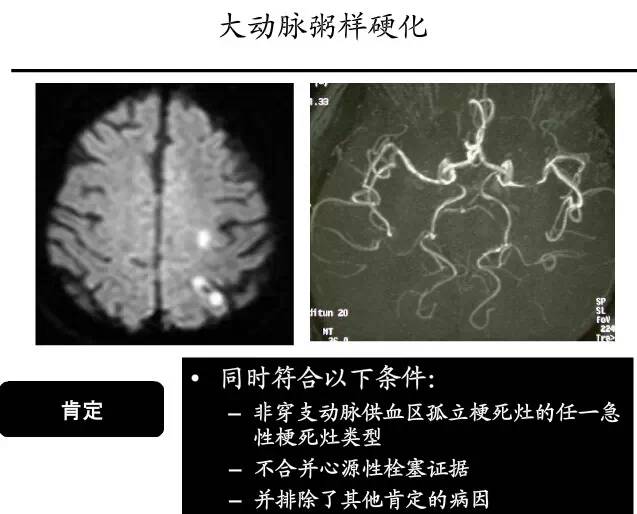 【PPT】猜责任血管与发病机制-64