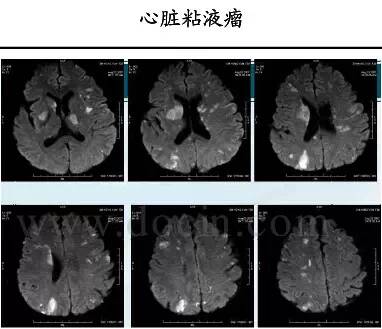 【PPT】猜责任血管与发病机制-68