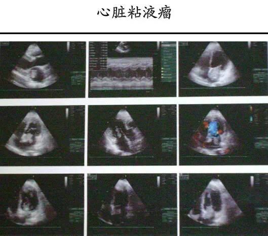 【PPT】猜责任血管与发病机制-69