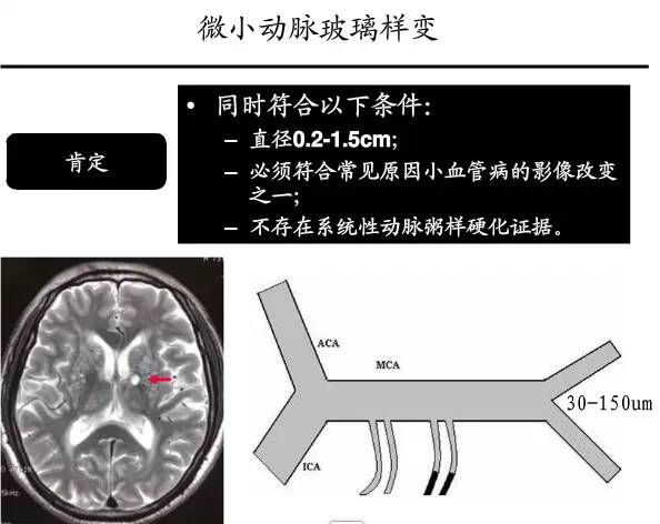 【PPT】猜责任血管与发病机制-70