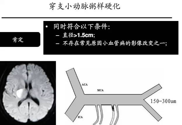 【PPT】猜责任血管与发病机制-71