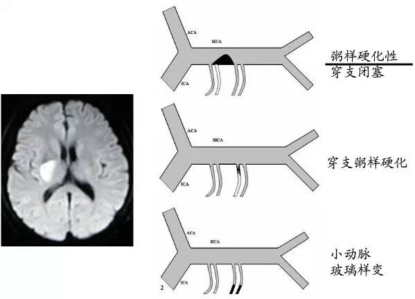 【PPT】猜责任血管与发病机制-72