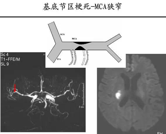 【PPT】猜责任血管与发病机制-74