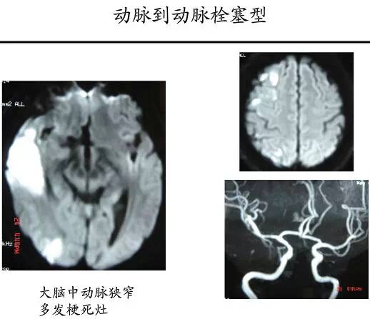 【PPT】猜责任血管与发病机制-76