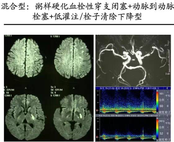 【PPT】猜责任血管与发病机制-81