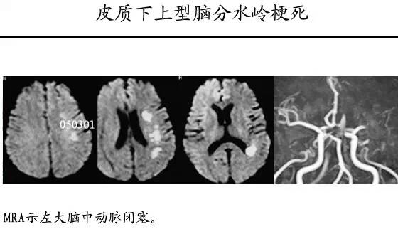 【PPT】猜责任血管与发病机制-84