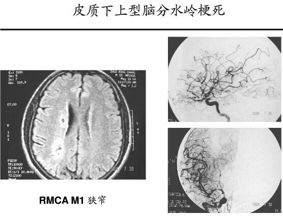 【PPT】猜责任血管与发病机制-85