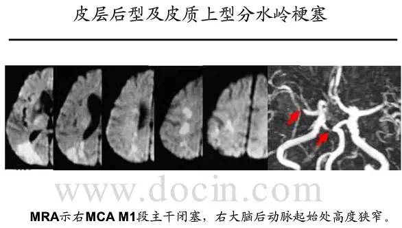 【PPT】猜责任血管与发病机制-86