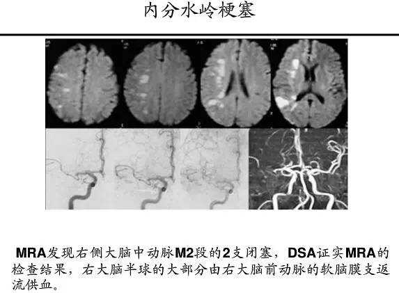 【PPT】猜责任血管与发病机制-87