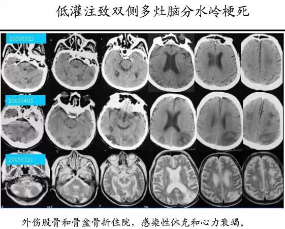 【PPT】猜责任血管与发病机制-88