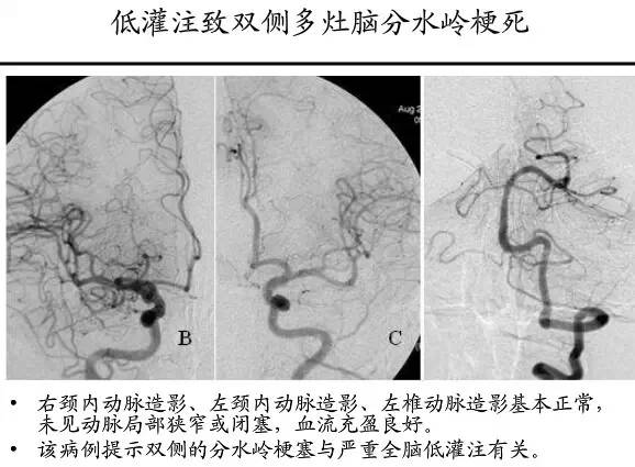 【PPT】猜责任血管与发病机制-89