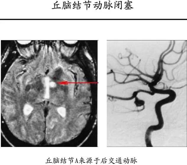 【PPT】猜责任血管与发病机制-93