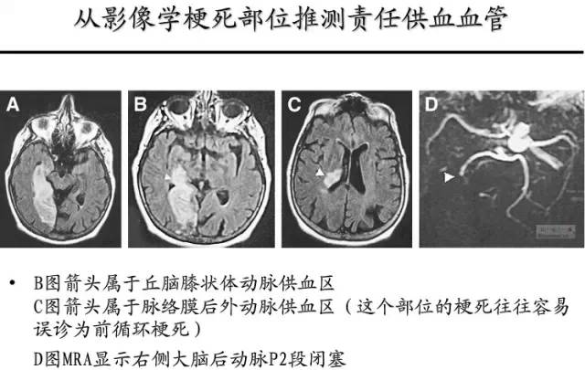 【PPT】猜责任血管与发病机制-94