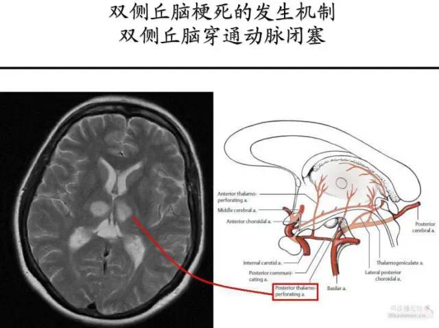 【PPT】猜责任血管与发病机制-95