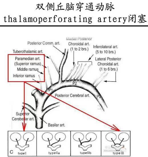 【PPT】猜责任血管与发病机制-96