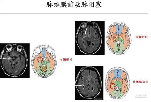 【PPT】猜责任血管与发病机制-101