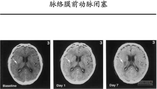 【PPT】猜责任血管与发病机制-102