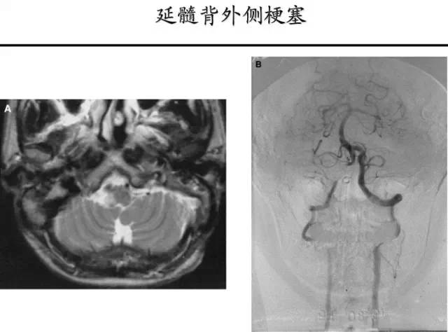 【PPT】猜责任血管与发病机制-105