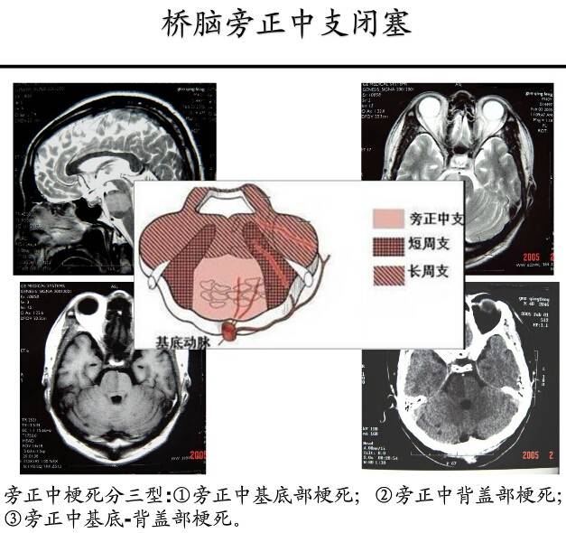 【PPT】猜责任血管与发病机制-104