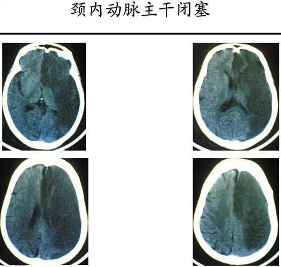 【PPT】猜责任血管与发病机制-107