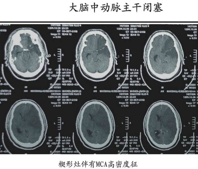 【PPT】猜责任血管与发病机制-108