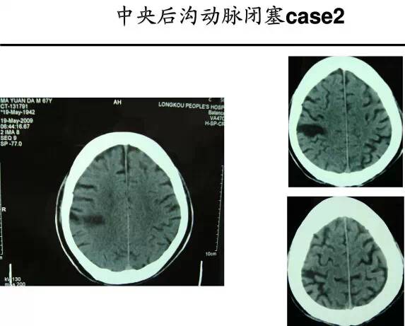 【PPT】猜责任血管与发病机制-112