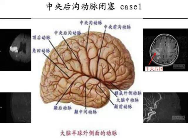 【PPT】猜责任血管与发病机制-111