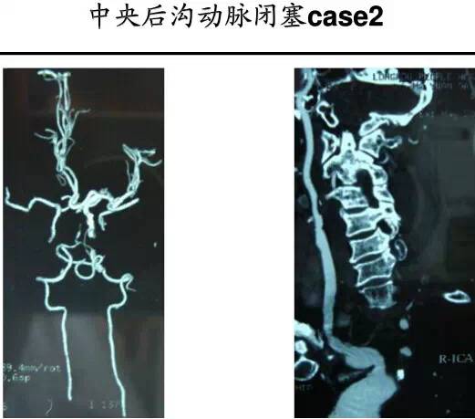 【PPT】猜责任血管与发病机制-113