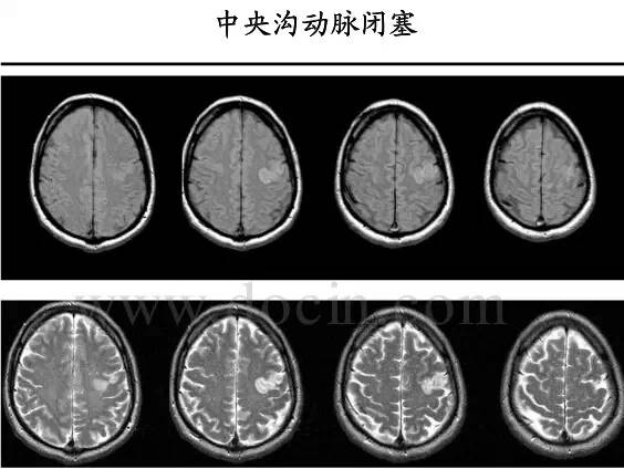 【PPT】猜责任血管与发病机制-120