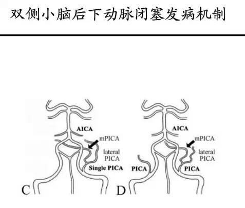 【PPT】猜责任血管与发病机制-121