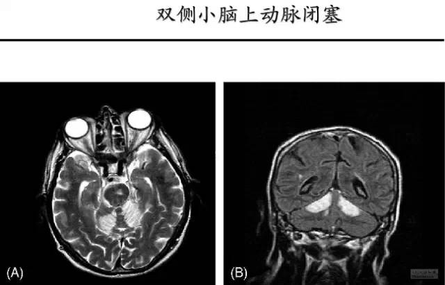 【PPT】猜责任血管与发病机制-124